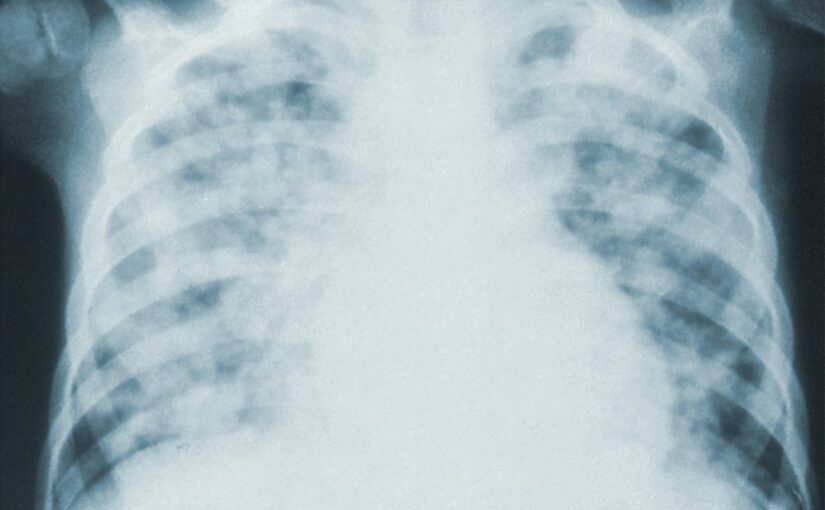 Syndrome De Rett Et Pathologies Apparentées